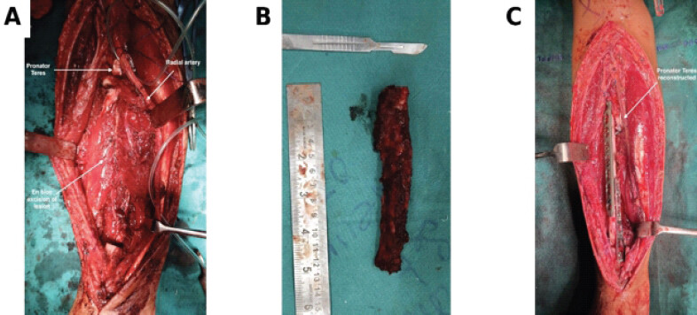 Figure 3: Wide excision and fibular graft reconstruction. (a) Intraoperative exposure of the radial shaft lesion demonstrating preservation of the radial artery and identification of the pronator teres during en bloc excision. (b) Excised radial shaft lesion following wide resection. The specimen measured approximately 5 cm in length and was submitted for definitive histopathological examination. (c) Reconstruction of the radial defect using the fibular autograft stabilized with plate fixation. The pronator teres tendon was reattached to the graft using a 2.8-mm suture anchor to restore forearm pronation following excision of the pronator quadratus.