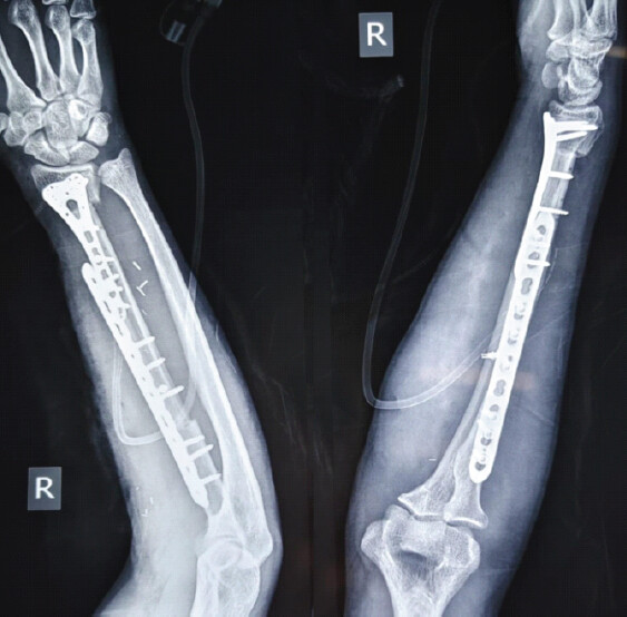 Figure 4: Immediate post-operative radiographic appearance. Immediate post-operative anteroposterior and lateral radiographs demonstrating fibular autograft reconstruction, restoration of radial continuity, and stable implant fixation.