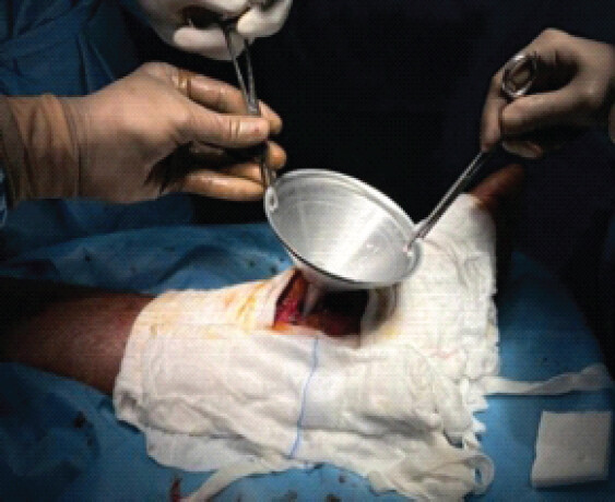 Figure 4: Usage of funnel for pouring liquid nitrogen for chemical cauterization.