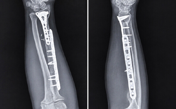 Figure 5: Follow-up radiographs showing fibular graft incorporation. Twelve-month follow-up radiographs demonstrating graft incorporation, maintained alignment, stable fixation, and absence of local recurrence.