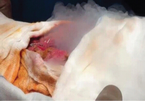 Figure 5: Usage of liquid nitrogen for chemical cauterization.