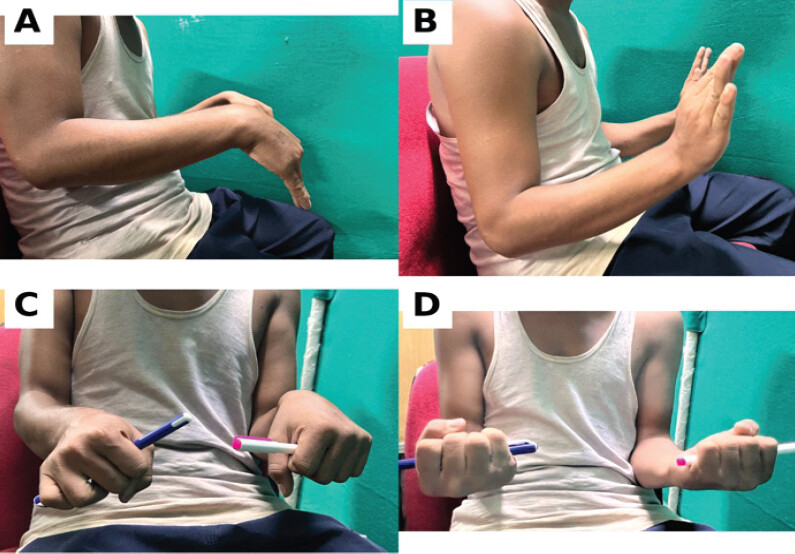 Figure 6: Clinical functional outcome at 12-month follow-up. Clinical photographs obtained at 12-month follow-up demonstrating satisfactory functional recovery following en bloc excision of the radial lesion and reconstruction with a non-vascularized fibular autograft. (a) Wrist flexion. (b) Wrist extension. (c) Forearm pronation. (d) Forearm supination. The patient achieved wrist flexion of 75°, wrist extension of 70°, forearm pronation of 80°, and forearm supination of 85°, with return to activities of daily living without significant limitation.