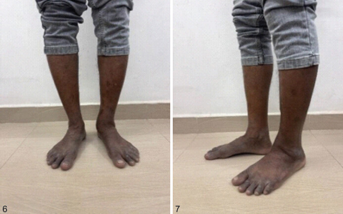 Figure 7: Post-operative clinical recovery of the patient post 8 weeks of surgery.
