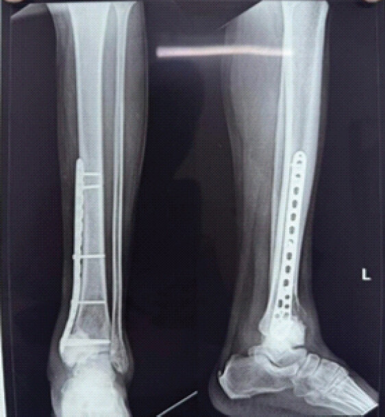Figure 8: Post-operative X-rays taken at 8 weeks