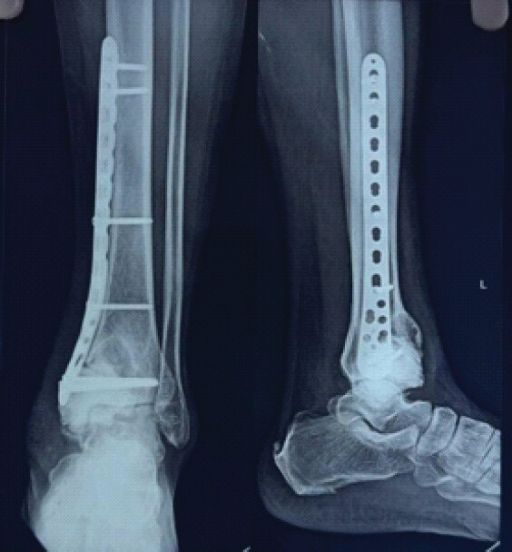 Figure 9: Post-operative X-rays taken at 12 weeks.