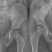 Figure 1: Sequential imaging of twin a at time of presentation, 3 months, 6 months and 1-year follow-up.