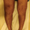 Superficial Femoral Artery Pseudoaneurysm after Total Knee Arthroplasty: An Uncommon Vascular Complication