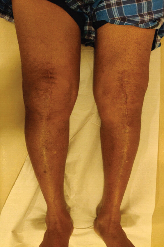 Figure 1: Clinical picture showing right knee and thigh swelling – 4-week post-operative. Clinical picture of both knees showing right knee and thigh swelling at 4-week post-operative period. Swelling is more compared to the left side.