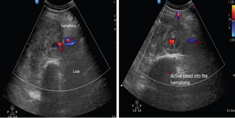 Figure 2: Doppler showing hematoma and active bleeding from a principal vessel. Venous and arterial Doppler showing hematoma in the thigh and active bleeding from the principal vessel.