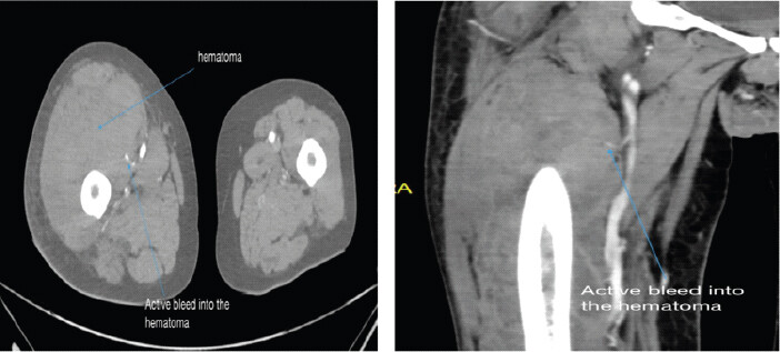 Figure 3: Computed tomography angiography axial and coronal images showing active bleeding from the pseudoaneurysm. Axial and coronal images showing hematoma and bleeding into the hematoma in the right vastus intermedius in the upper thigh. Bleeding identified from the pseudoaneurysm of the third muscular branch of superficial femoral artery.
