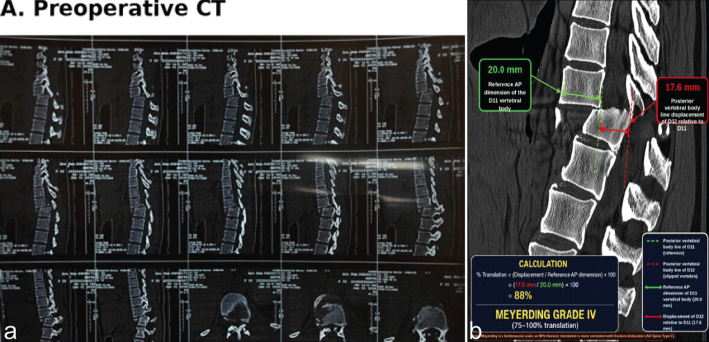 Figure 1: Pre-operative imaging. (a) Pre-operative sagittal computed tomography demonstrating approximately 88% anterior translation of D11 relative to D12, consistent with Meyerding Grade IV traumatic spondylolisthesis. (b) Diagrammatic representation of the Meyerding measurement method applied to this case, showing the reference anteroposterior dimension of the D11 vertebral body (20.0 mm) and the posterior vertebral body line displacement of D12 relative to D11 (17.6 mm), yielding 88% translation (Meyerding Grade IV).