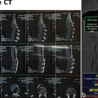 Figure 1: Pre-operative imaging. (a) Pre-operative sagittal computed tomography demonstrating approximately 88% anterior translation of D11 relative to D12, consistent with Meyerding Grade IV traumatic spondylolisthesis. (b) Diagrammatic representation of the Meyerding measurement method applied to this case, showing the reference anteroposterior dimension of the D11 vertebral body (20.0 mm) and the posterior vertebral body line displacement of D12 relative to D11 (17.6 mm), yielding 88% translation (Meyerding Grade IV).