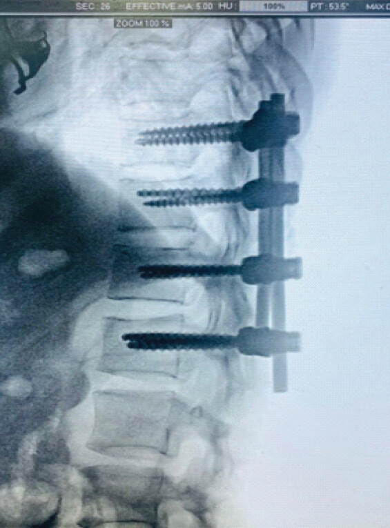 Figure 2: Post-operative fixation. Intraoperative/post-operative fluoroscopic image demonstrating D10–L1 posterior pedicle screw-rod fixation with restoration of alignment.