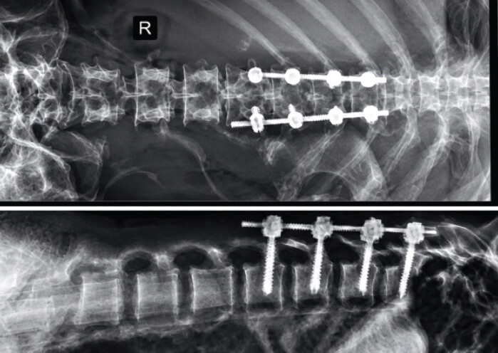 Figure 3: Six-month follow-up. Anteroposterior and lateral radiographs demonstrating maintained reduction, satisfactory implant position, and no evidence of construct failure. Patient-identifying information has been removed from all images.