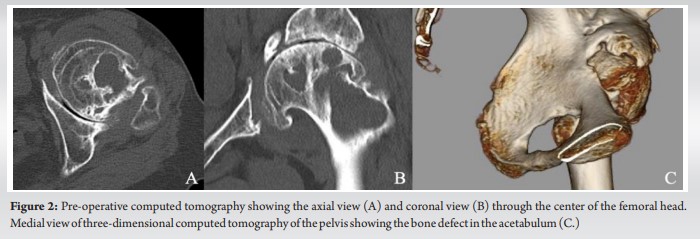 Rupture Of External Iliac Artery During Total Hip Arthroplasty After ...