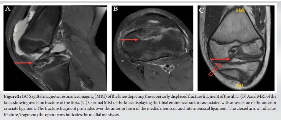 Tibial Eminence Fracture and Pediatric ACL Avulsion Diagnosis and ...