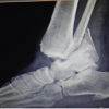 Single-Stage Hybrid Fixation of a Grade III Open, Unstable Trimalleolar Ankle Fracture with Syndesmotic Disruption and Posterior Talar Subluxation