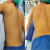 Recurrent Ventral Scapular Osteochondroma Presenting with Pseudo-winging in an Adolescent: A Case Report and Follow-up of a Previously Published Case