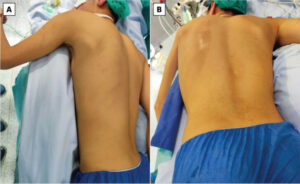 Figure 1: Pre-operative prone views obtained after induction of anesthesia, demonstrating recurrent asymmetric prominence of the left scapula. (a) Posterior overview. (b) Closer oblique view.