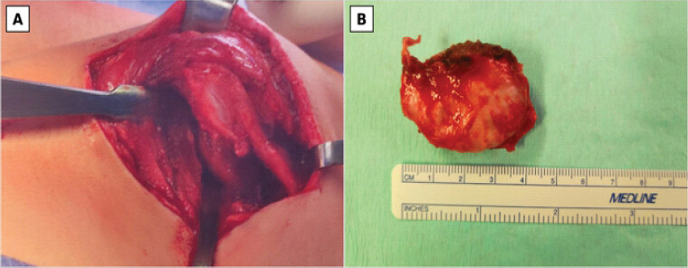 Figure 2: Revision surgery. (a) Exposure of the recurrent ventral scapular osteochondroma through a posterior parascapular approach. (b) Resected specimen displayed alongside a metric scale.