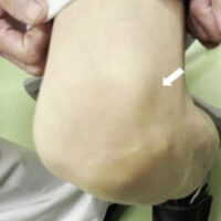 Figure 1: The bony prominence is noted on the lateral aspect of the patella (white arrow). There was tenderness in the same area, and a snapping sensation occurred during knee flexion.
