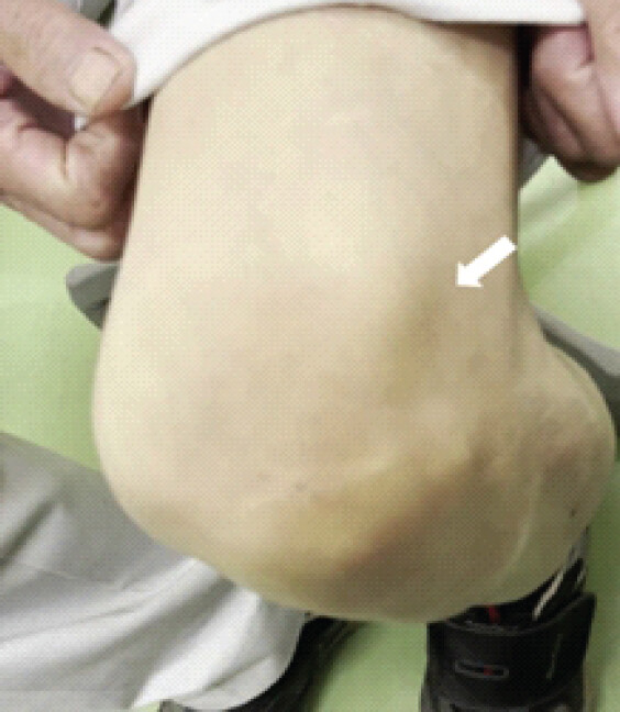 Figure 1: The bony prominence is noted on the lateral aspect of the patella (white arrow). There was tenderness in the same area, and a snapping sensation occurred during knee flexion.