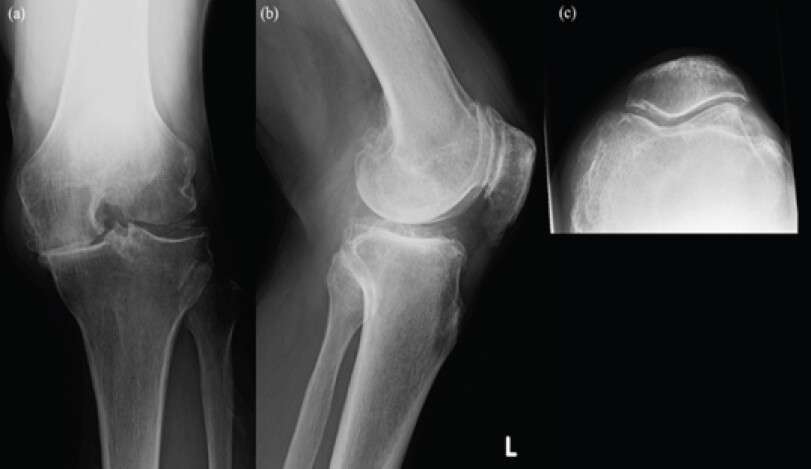 Figure 2: (a) Rosenberg view, (b) lateral view, and (c) skyline view. The medial joint space has disappeared, and a partial bone defect has also occurred; the knee was diagnosed with knee osteoarthritis of Kellgren-Lawrence classification Grade 4. The osteophytes were formed medial, lateral, and patellofemoral joints.