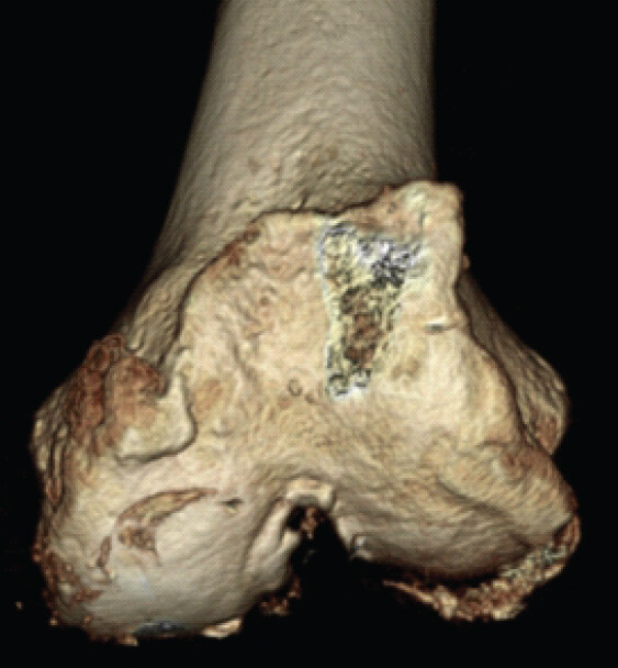 Figure 3: An osteophyte is identified at the location corresponding to the bulging area observed on physical examination in the three-dimensional reconstructed image.