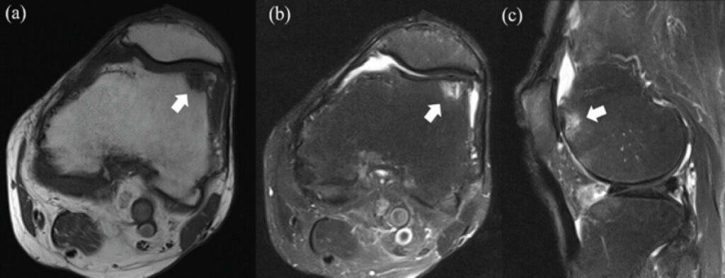Figure 4: Bone marrow edema is observed in the osteophyte area on the lateral side of the femoral trochlea (white arrow). (a) Axial view of T1-weighted image (b) axial view of fat-suppressed T2-weighted image (c) sagittal view of fat-suppressed T2-weighted image.