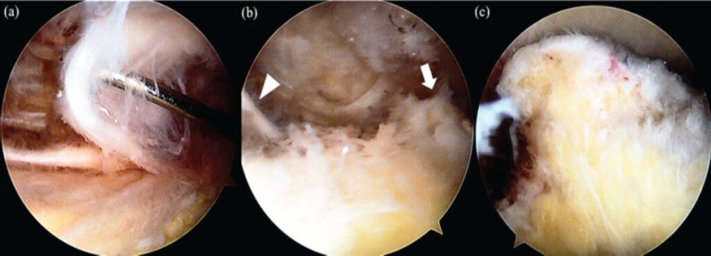 Figure 5: Arthroscopic findings from the superior medial portal reveal the osteophyte (white arrow) and a cord-like structure extending dorsally from the quadriceps tendon (white arrowhead). (a) a cord-like structure (b) osteophyte and cord-like structure (c) osteophyte after removal of surrounding soft tissue.