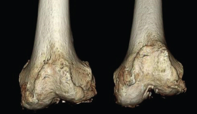 Figure 6: Post-operative three-dimensional reconstructed computed tomography confirmed that the osteophytes causing symptoms had been adequately resected.