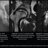 Total Hip Arthroplasty for Advanced Femoral Head Osteonecrosis in a 24-Year-Old Competitive Wrestler: A Case Report