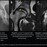 Figure 1: (a, b, and c) pre-operative imaging demonstrating advanced osteonecrosis of the right femoral head with collapse and secondary degenerative change.