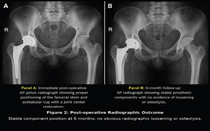 Figure 2: Post-operative radiographic outcome following total hip arthroplasty. The figure shows immediate post-operative and 6-month representative radiographs; radiographs at 9 months were also normal, with stable component position and no obvious radiographic loosening or osteolysis.