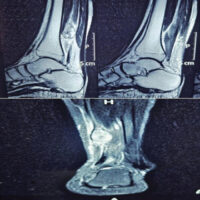 Figure 1: Magnetic resonance imaging left leg T2-weighted images dated on July 10, 2024, showing a well-demarcated, well-circumscribed hyper intensed lesion of size (14 × 15 × 25) mm in the course of the tibial nerve.
