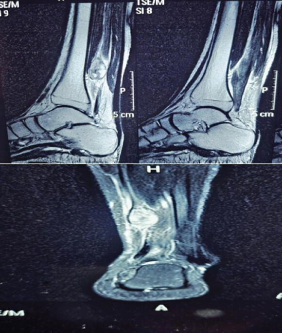 Figure 1: Magnetic resonance imaging left leg T2-weighted images dated on July 10, 2024, showing a well-demarcated, well-circumscribed hyper intensed lesion of size (14 × 15 × 25) mm in the course of the tibial nerve.