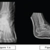 Ipsilateral Fracture of the Talus with Sustentaculum Tali of the Calcaneus with a Modified Anteromedial Surgical Approach: A Case Report