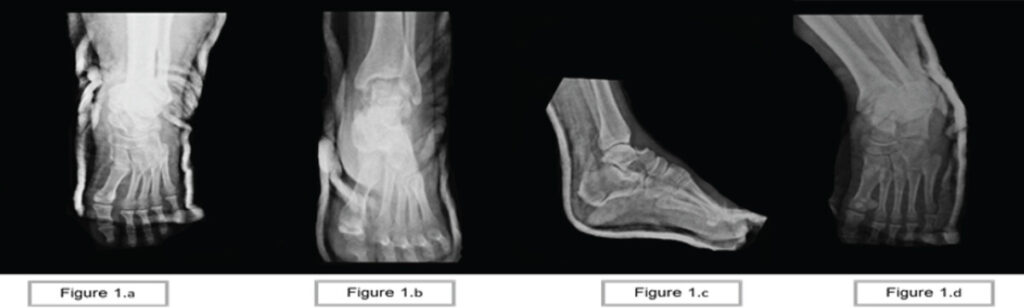 Figure 1: (a-d) X-ray of the left ankle shows a left talus fracture at the neck, and a sustentaculum tali fracture of the calcaneus.