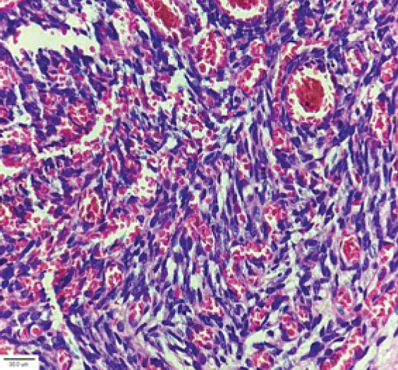 Figure 2: Ultrasonography-guided biopsy which showed schwannoma. Two growth patterns (1) Antoni A – Nuclear palisading region, (2) Antoni B - Less cellular fibrous region. Slide shows prominent Antoni B region.