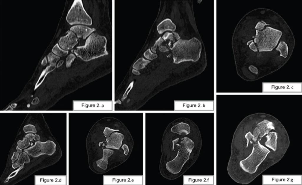 Figure 2: (a-g) Computed tomography scan shows left talus fracture with talonavicular and subtalar joint extension, and a comminuted fracture of sustentaculum tali of the calcaneus.