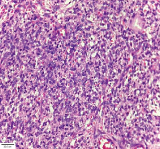 Figure 3: Histopathological examination reported as a spindle cell neoplasm sarcomatous in nature.