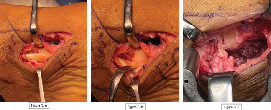 Figure 3: (a) The posterior tibial tendon was identified. (b) The deep deltoid ligament had an avulsed tear. (c) Fixation of the sustentaculum tali of the calcaneus with two Herbert screws 4.0 mm.