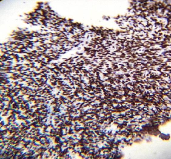 Figure 4: Immunohistochemistry report: Synovial sarcoma diagnosis.