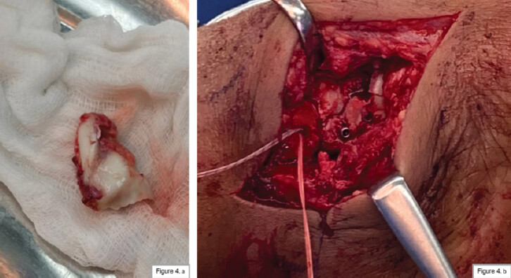 Figure 4: (a and b) Talus fragment reduction and fixation with Herbert screw, and deltoid ligament repair with anchor suture.