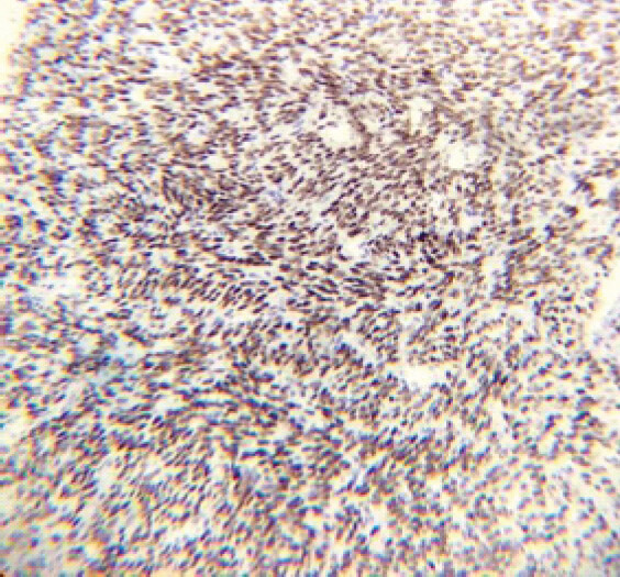 Figure 5: Immunohistochemical transducing – like enhancer 1 – almost diagnostic for synovial sarcoma.