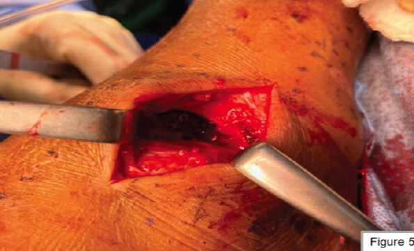 Figure 5: Lateral approach to the ankle utilized to apply a buttressing mini fragment plate.