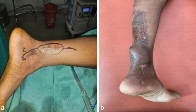 Figure 6: Surgical incision. (a) Surgical incision incorporating previous surgery scar for wide marginal excision of tibial nerve planned on date August 28, 2024. (b) 2 years and 4 months follow-up clinical picture shows cavus foot with clawing of toes, healed neurocutaneous rotational flap.