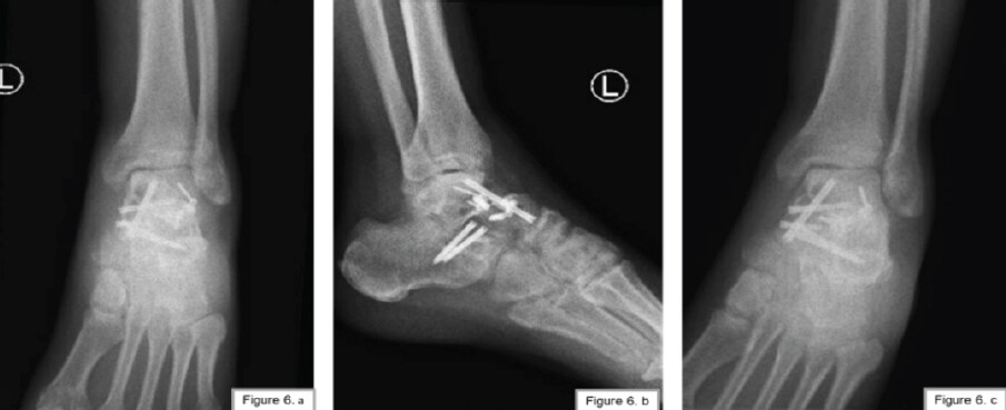 Figure 6: (a-c) Five months postoperatively.