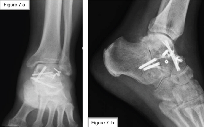 Figure 7: (a and b) 10 months postoperatively.