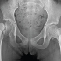 Figure 1: Initial radiograph. Bilateral coxa vara was observed, and the right proximal femoral physis was widened, with displacement of the capital femoral epiphysis and a triangular metaphyseal fragment.